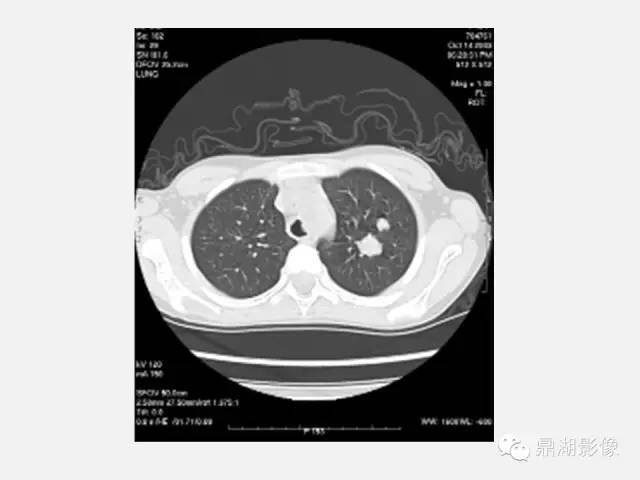 【PPT】肺内多发空洞和囊性病变诊断与鉴别诊断