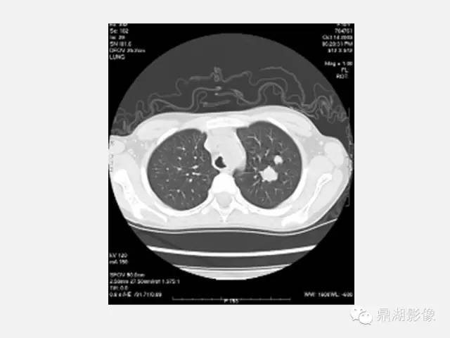 【PPT】肺内多发空洞和囊性病变诊断与鉴别诊断