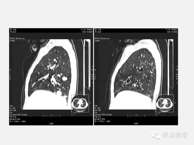 【PPT】肺内多发空洞和囊性病变诊断与鉴别诊断