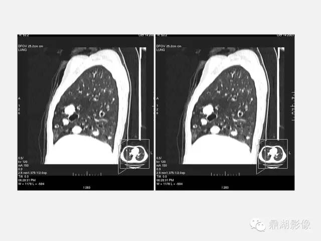 【PPT】肺内多发空洞和囊性病变诊断与鉴别诊断