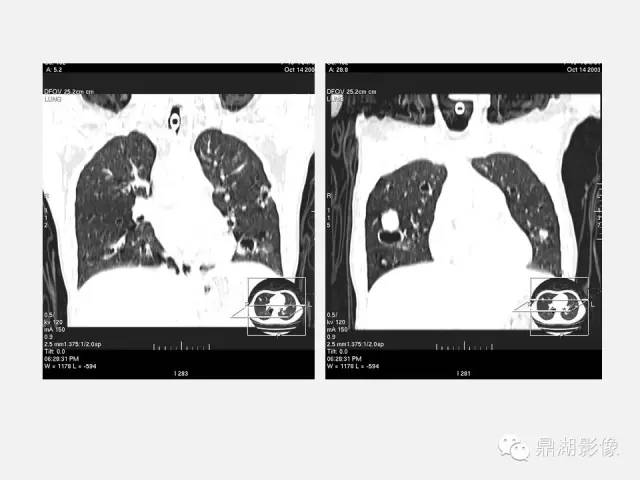 【PPT】肺内多发空洞和囊性病变诊断与鉴别诊断