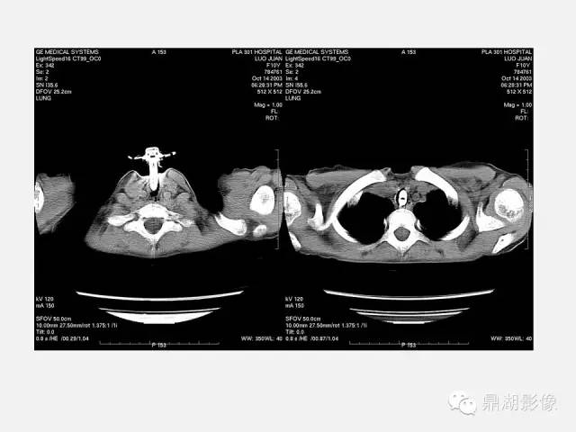 【PPT】肺内多发空洞和囊性病变诊断与鉴别诊断