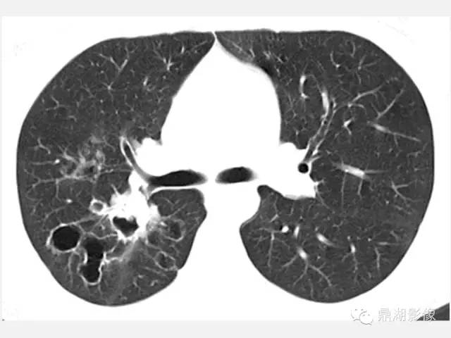 【PPT】肺内多发空洞和囊性病变诊断与鉴别诊断