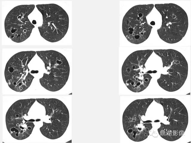 【PPT】肺内多发空洞和囊性病变诊断与鉴别诊断