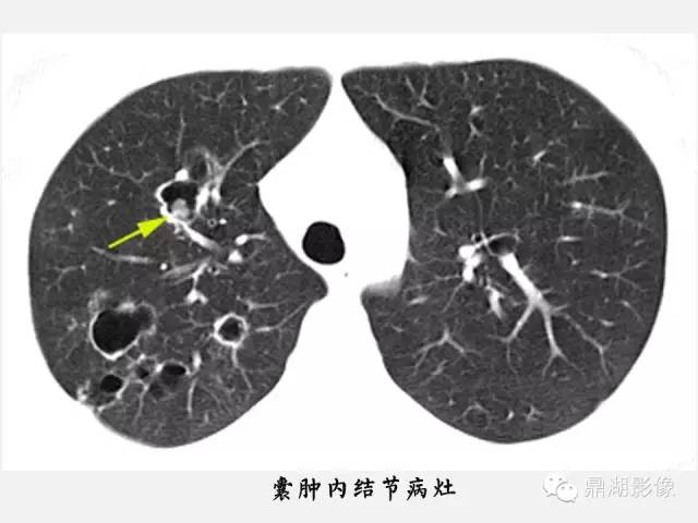 【PPT】肺内多发空洞和囊性病变诊断与鉴别诊断