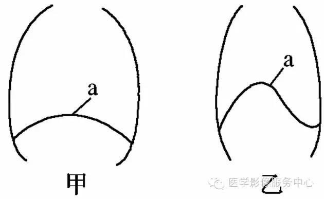 膈肌（横膈）的X线表现