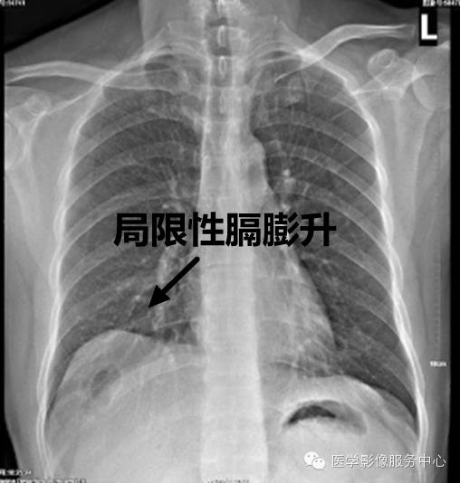 膈肌（横膈）的X线表现