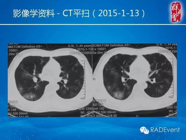 【病例】毛霉菌肺炎1例CT影像表现