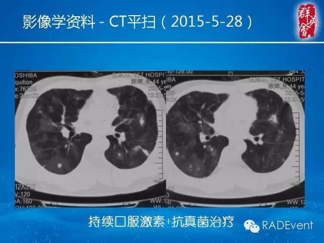 【病例】毛霉菌肺炎1例CT影像表现