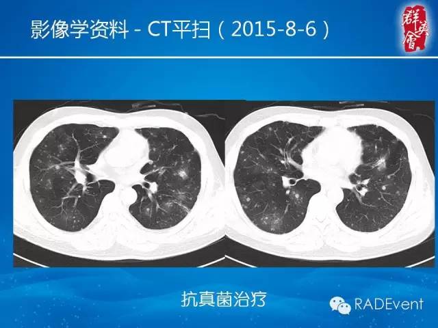 【病例】毛霉菌肺炎1例CT影像表现