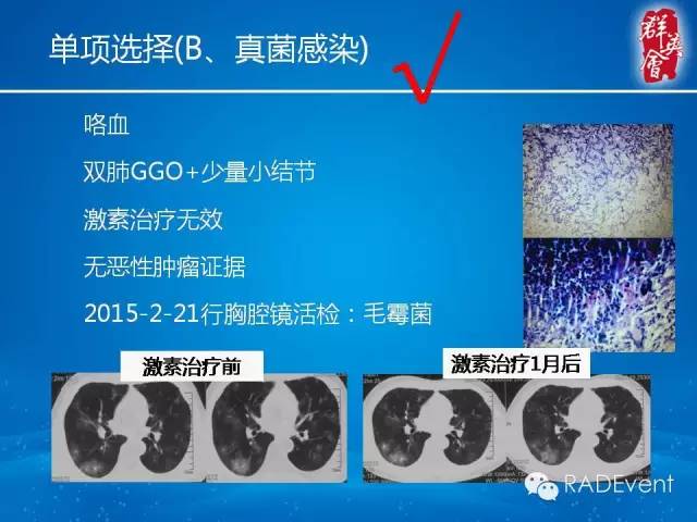 【病例】毛霉菌肺炎1例CT影像表现
