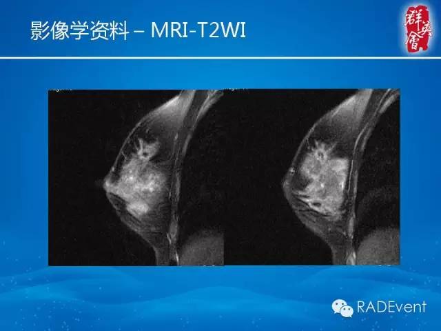 【病例】乳腺硬化性腺病1例MR影像表现