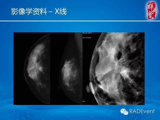 【病例】乳腺硬化性腺病1例MR影像表现