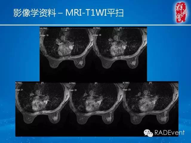 【病例】乳腺硬化性腺病1例MR影像表现