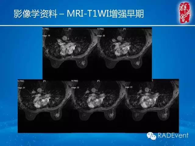 【病例】乳腺硬化性腺病1例MR影像表现