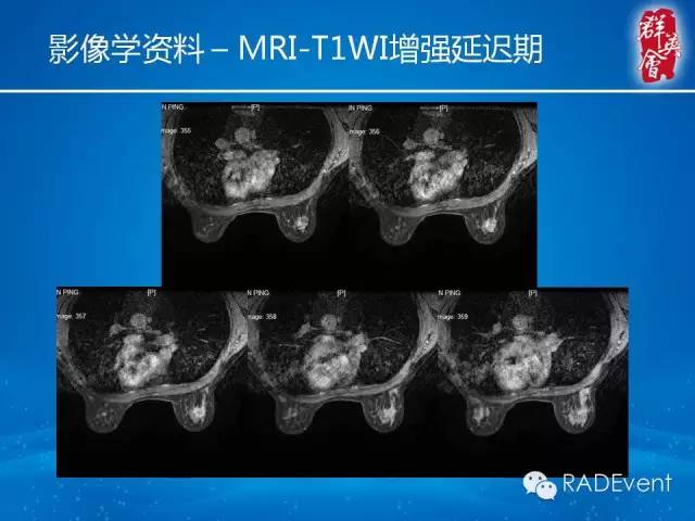 【病例】乳腺硬化性腺病1例MR影像表现