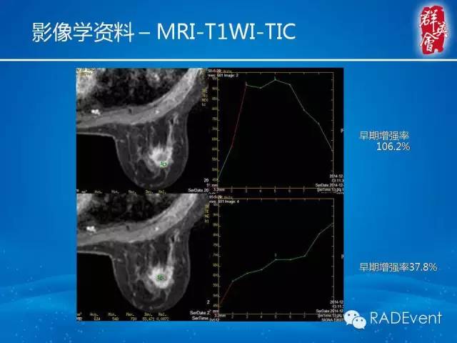 【病例】乳腺硬化性腺病1例MR影像表现