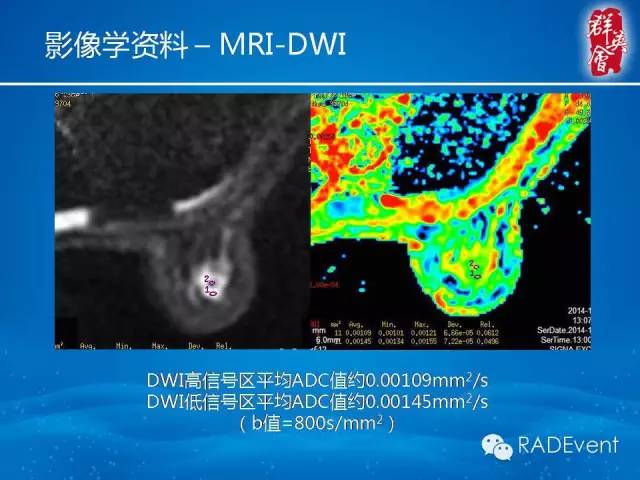 【病例】乳腺硬化性腺病1例MR影像表现