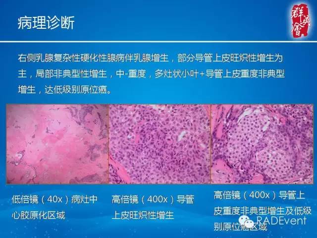【病例】乳腺硬化性腺病1例MR影像表现