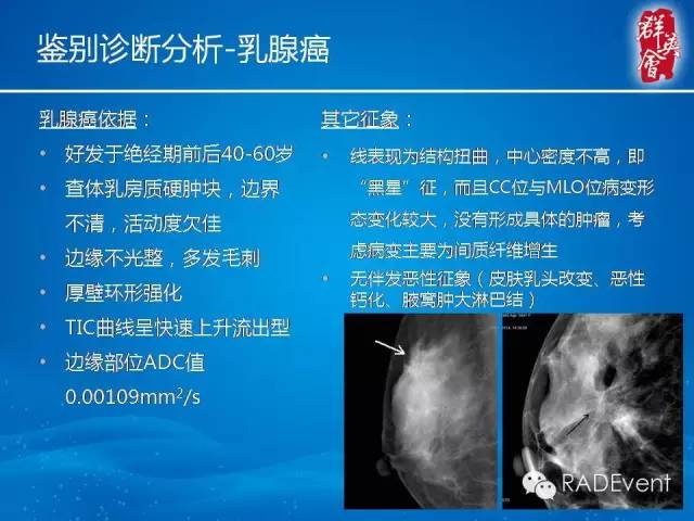 【病例】乳腺硬化性腺病1例MR影像表现