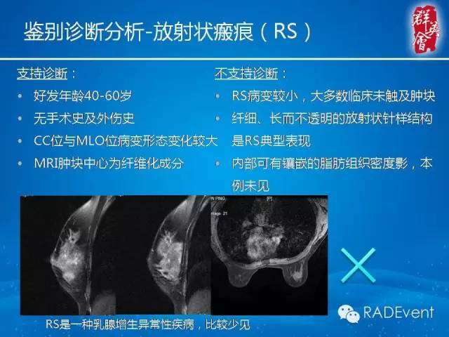 【病例】乳腺硬化性腺病1例MR影像表现