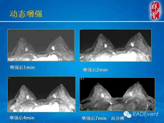 【病例】乳腺多发占位MR一例