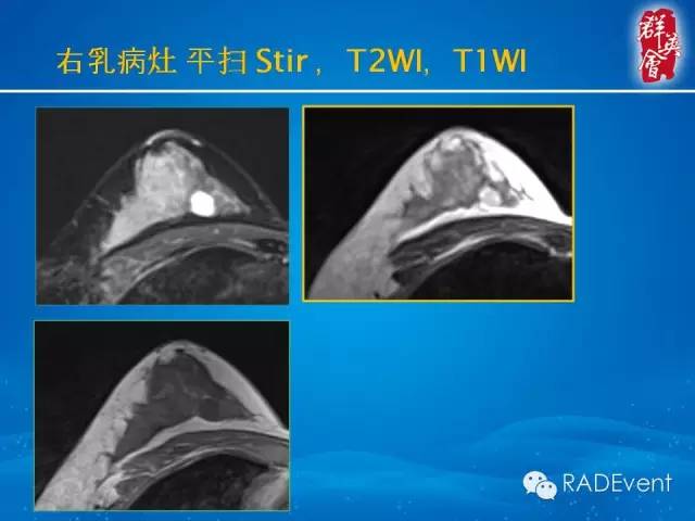 【病例】乳腺多发占位MR一例