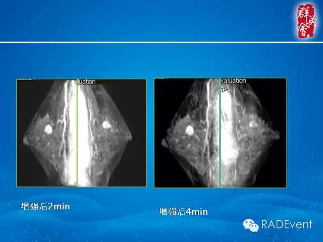 【病例】乳腺多发占位MR一例