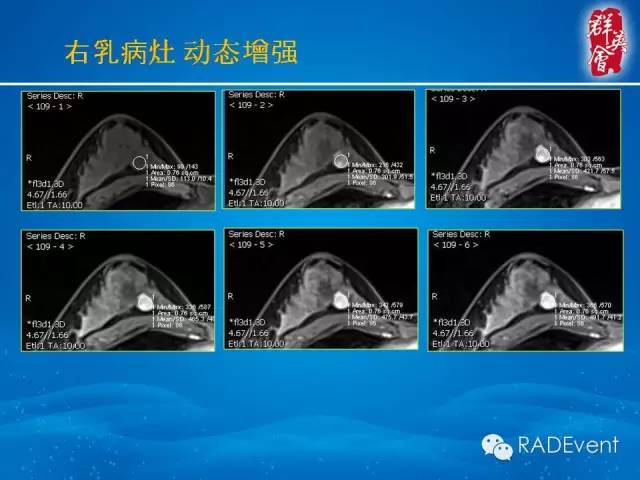 【病例】乳腺多发占位MR一例