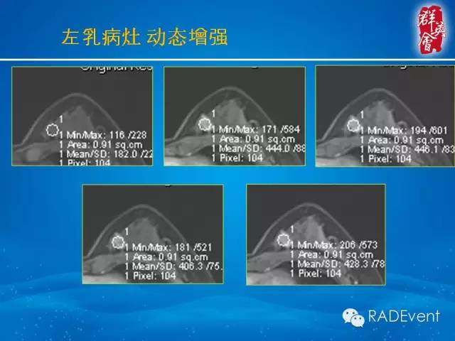 【病例】乳腺多发占位MR一例