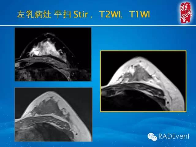 【病例】乳腺多发占位MR一例