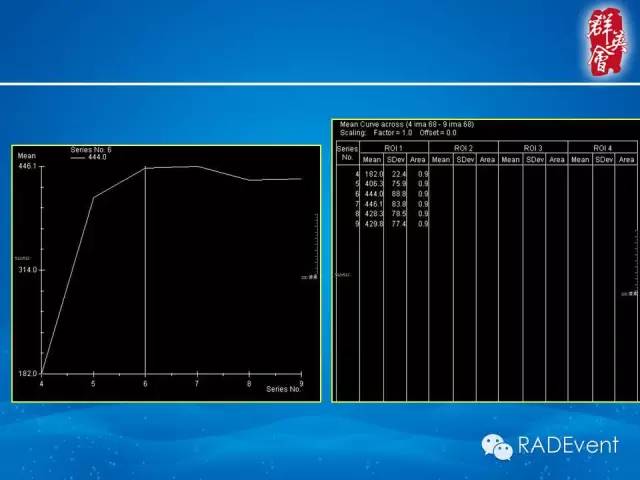 【病例】乳腺多发占位MR一例