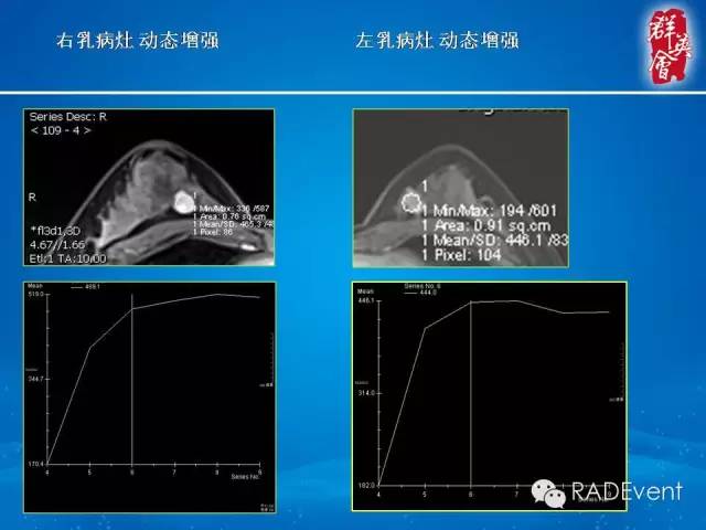 【病例】乳腺多发占位MR一例