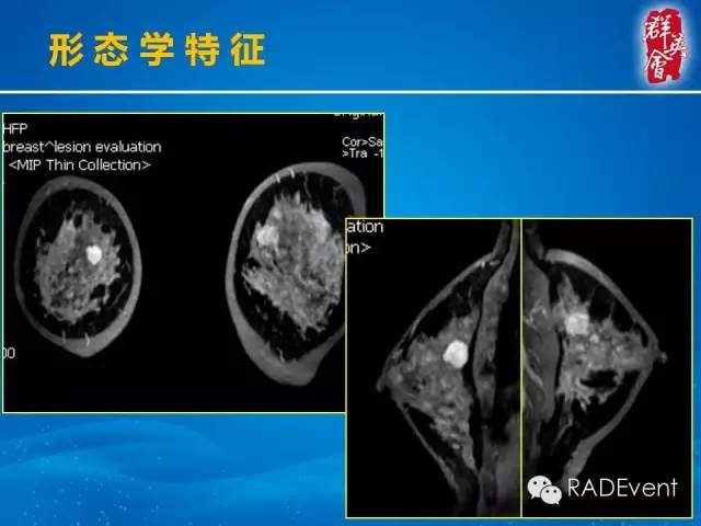 【病例】乳腺多发占位MR一例