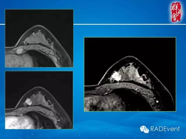 【病例】乳腺多发占位MR一例