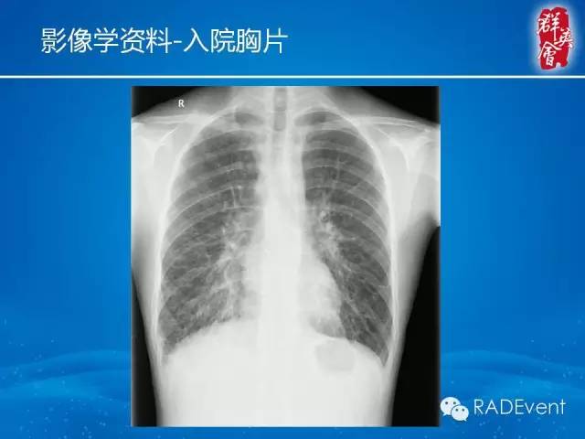 【病例】弥漫性肺淋巴管瘤病1例CT影像表现