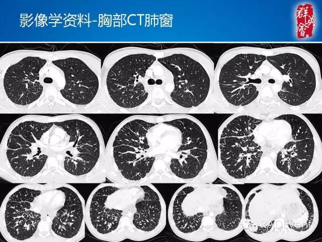 【病例】弥漫性肺淋巴管瘤病1例CT影像表现