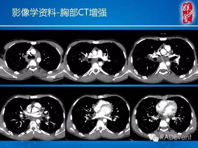 【病例】弥漫性肺淋巴管瘤病1例CT影像表现