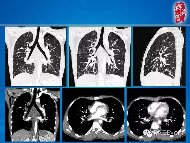 【病例】弥漫性肺淋巴管瘤病1例CT影像表现