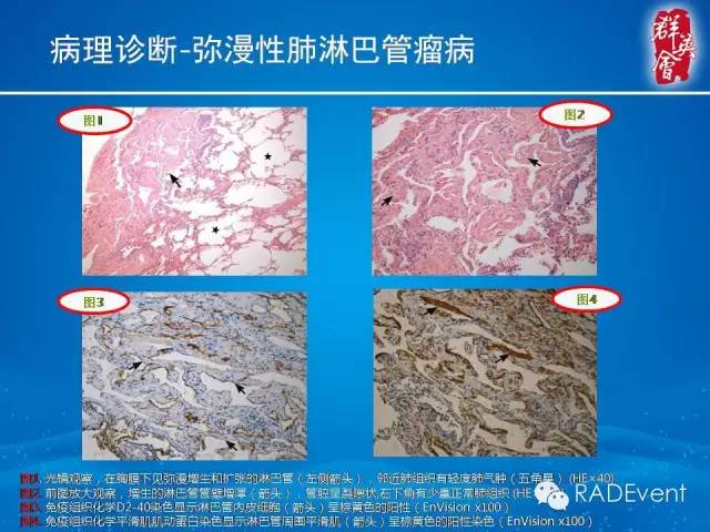 【病例】弥漫性肺淋巴管瘤病1例CT影像表现