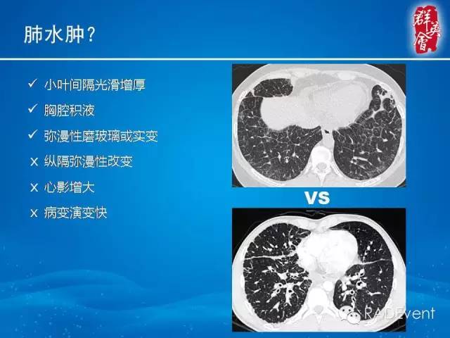【病例】弥漫性肺淋巴管瘤病1例CT影像表现