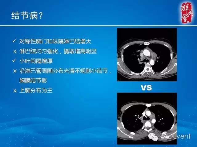 【病例】弥漫性肺淋巴管瘤病1例CT影像表现
