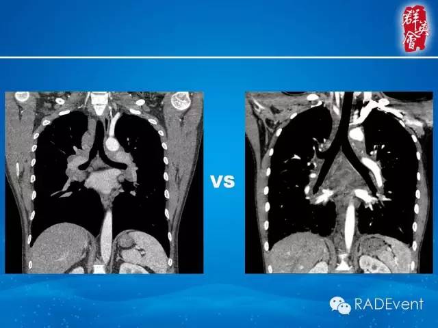 【病例】弥漫性肺淋巴管瘤病1例CT影像表现