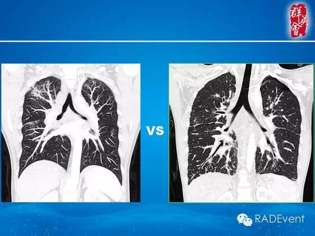 【病例】弥漫性肺淋巴管瘤病1例CT影像表现