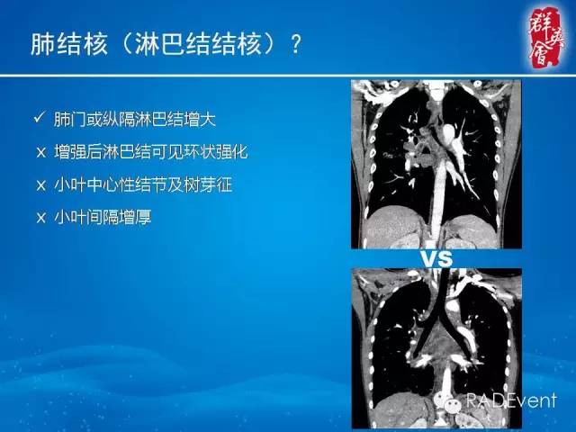 【病例】弥漫性肺淋巴管瘤病1例CT影像表现