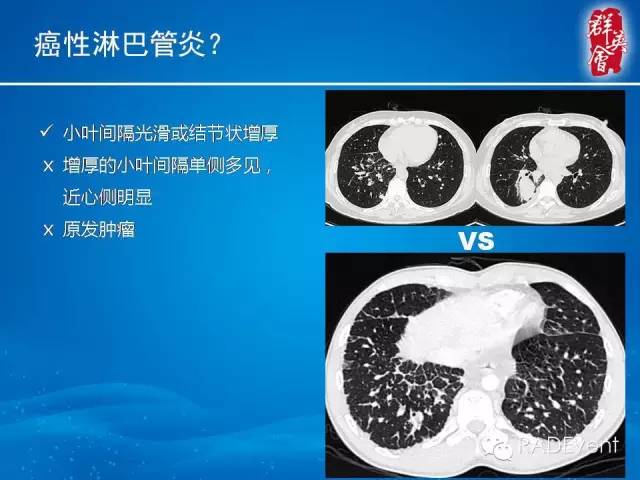 【病例】弥漫性肺淋巴管瘤病1例CT影像表现