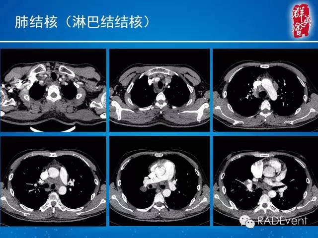 【病例】弥漫性肺淋巴管瘤病1例CT影像表现