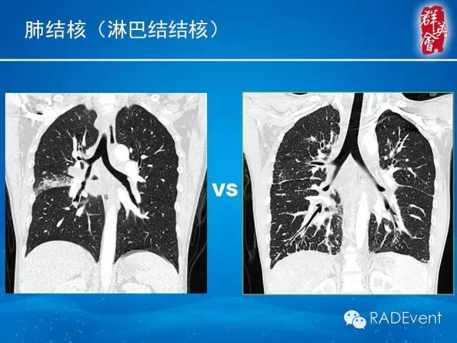 【病例】弥漫性肺淋巴管瘤病1例CT影像表现