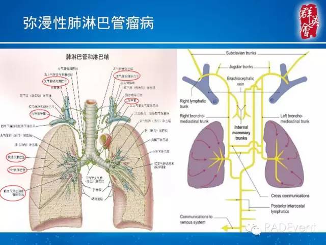 【病例】弥漫性肺淋巴管瘤病1例CT影像表现