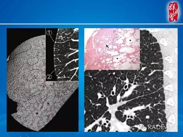 【病例】弥漫性肺淋巴管瘤病1例CT影像表现